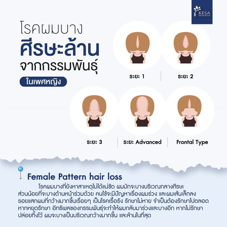 ผมบางกรรมพันธุ์ ผู้หญิง เกศา คลินิก - kesa hair clinic