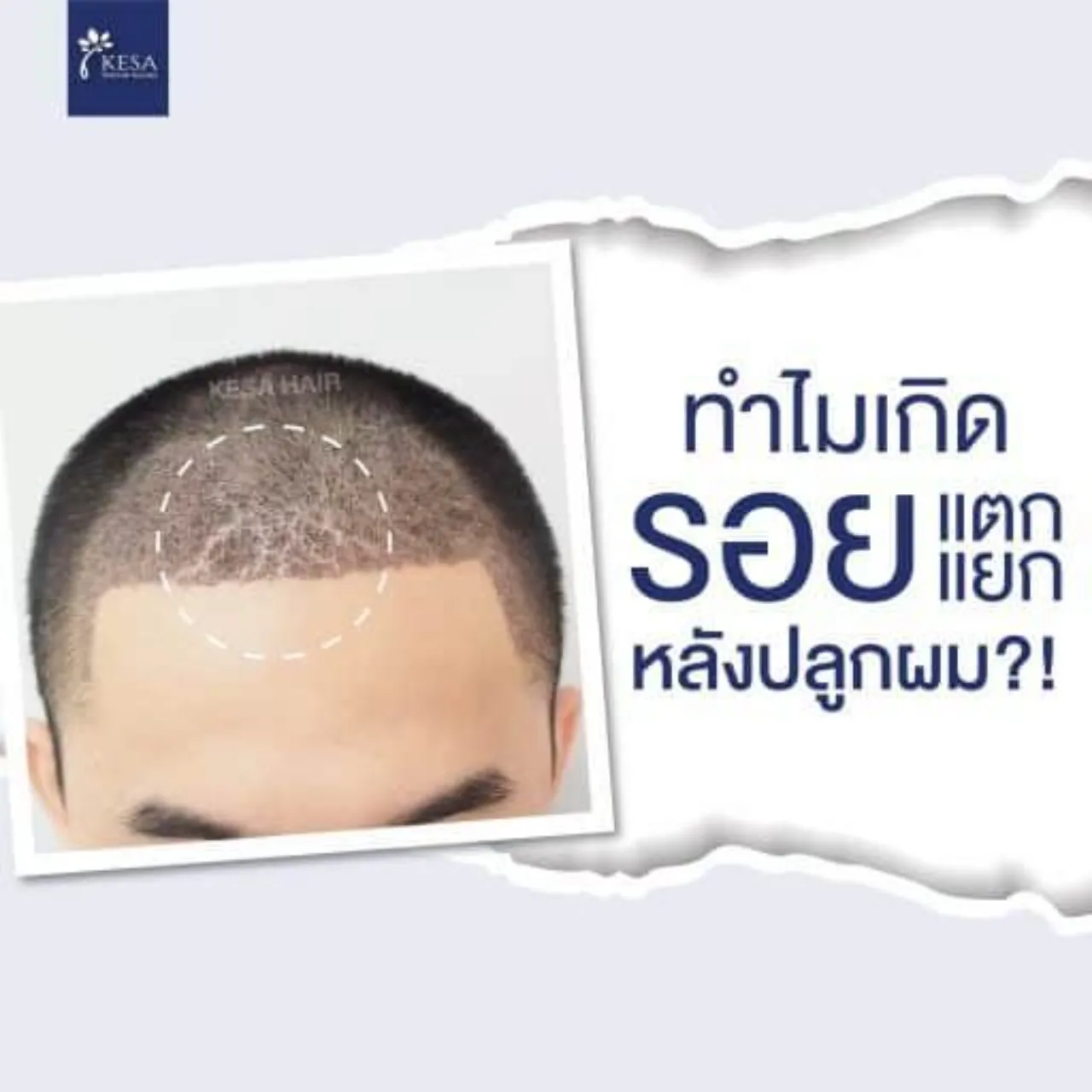 คนไข้มักตกใจกับรอยแผลแยกหลังปลูกผม
