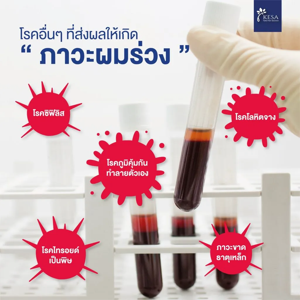 ภาวะผมร่วง