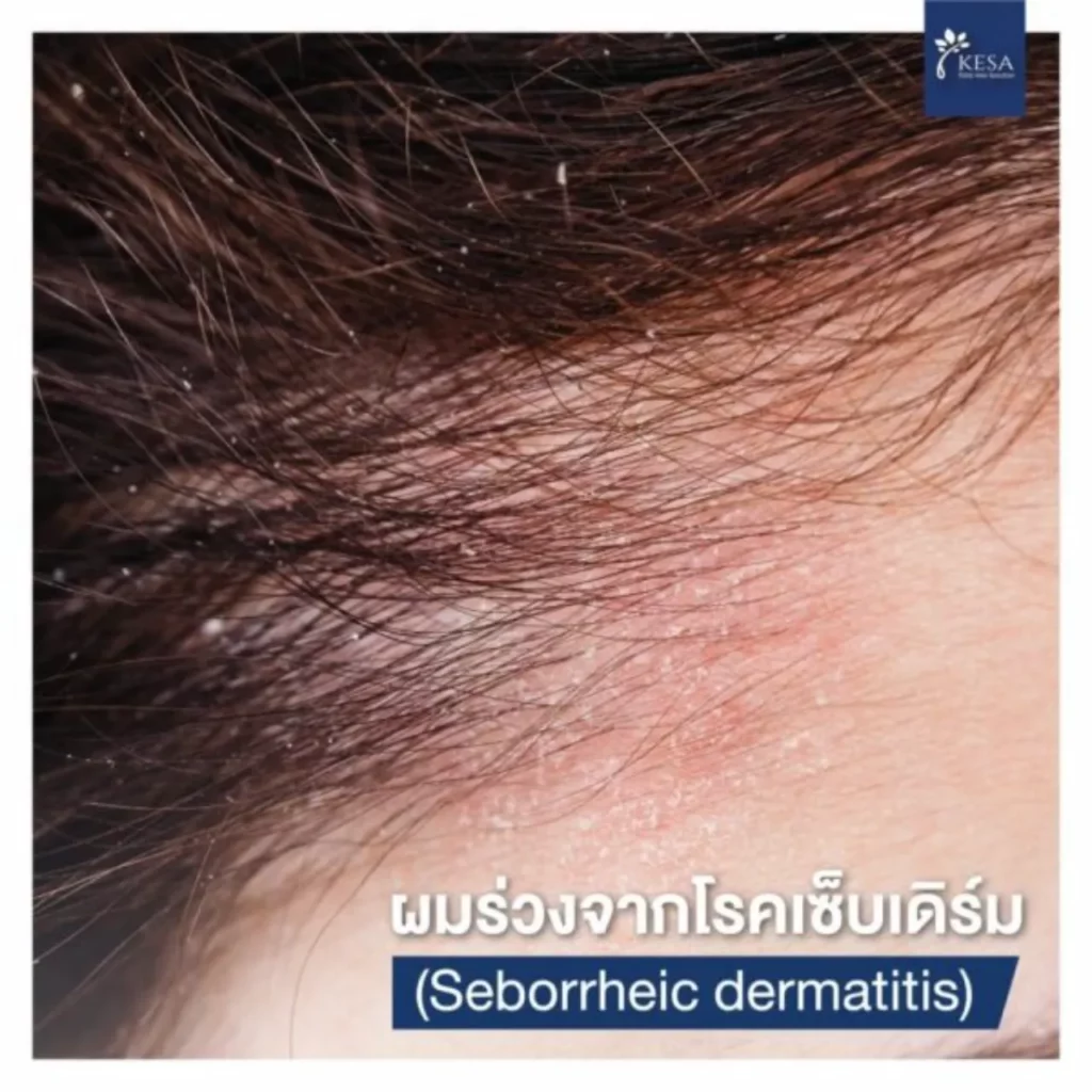 ผมร่วงจากโรคเซ็บเดิร์ม Seborrheic dermatitis เกศา คลินิก - kesa hair clinic เกศา คลินิก - kesa hair clinic