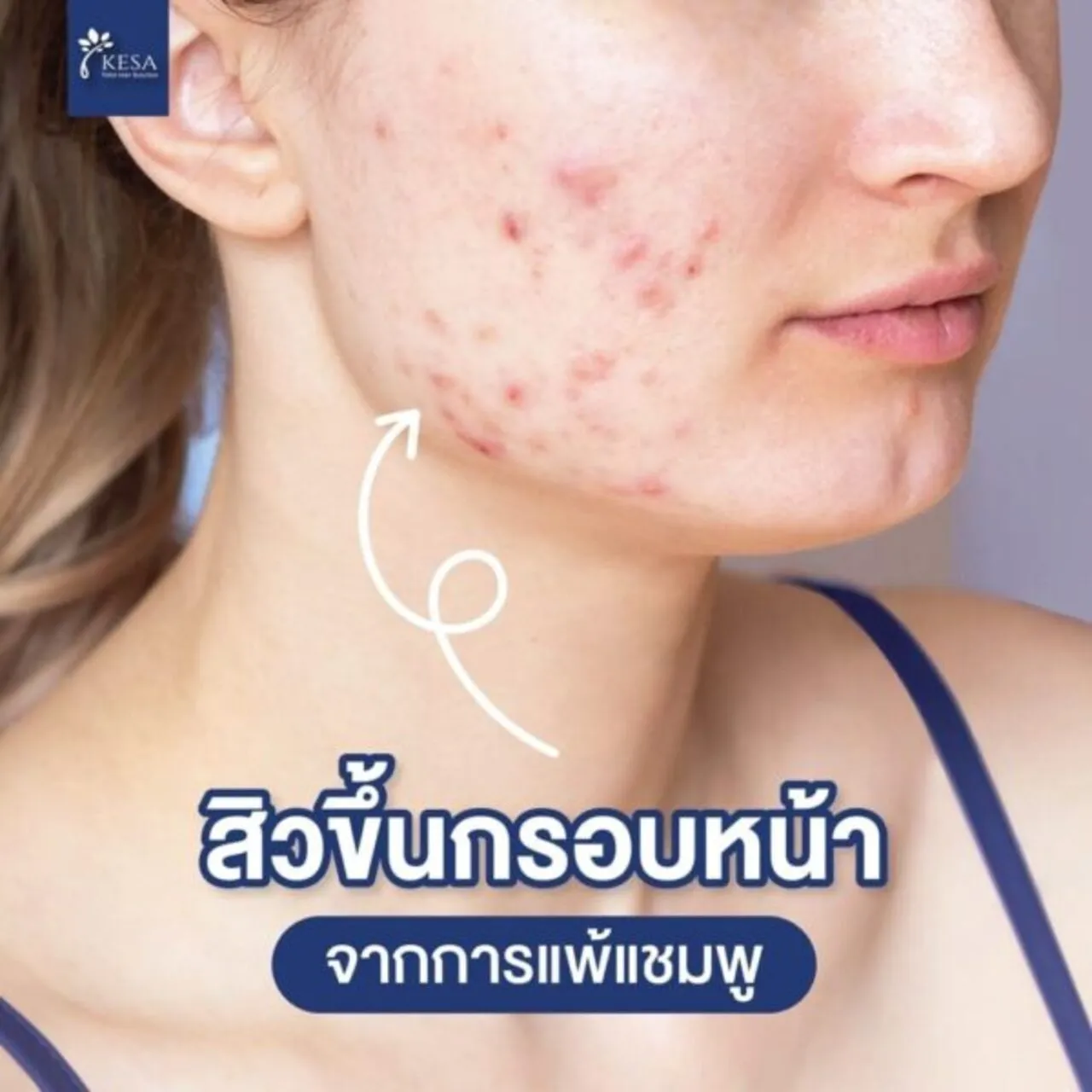 เป็น สิว กรอบหน้า เพราะ แพ้แชมพู