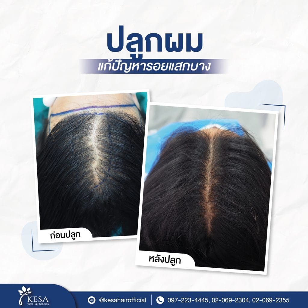  เกศา คลินิก - kesa hair clinic