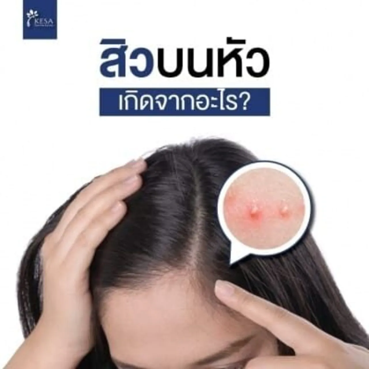 สิว บนหัว เกิดจากอะไร?