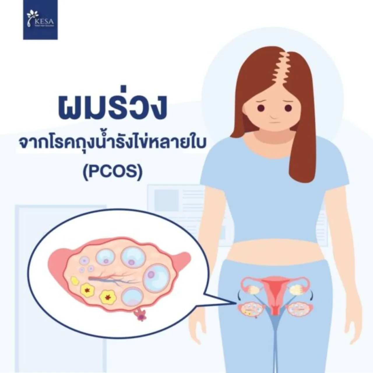 ผมร่วงจากโรคถุงน้ำรังไข่หลายใบ (PCOS)