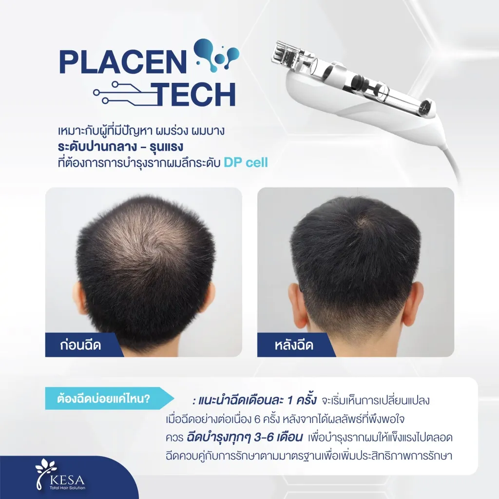ฉีดบำรุงผม เกศา คลินิก - kesa hair clinic