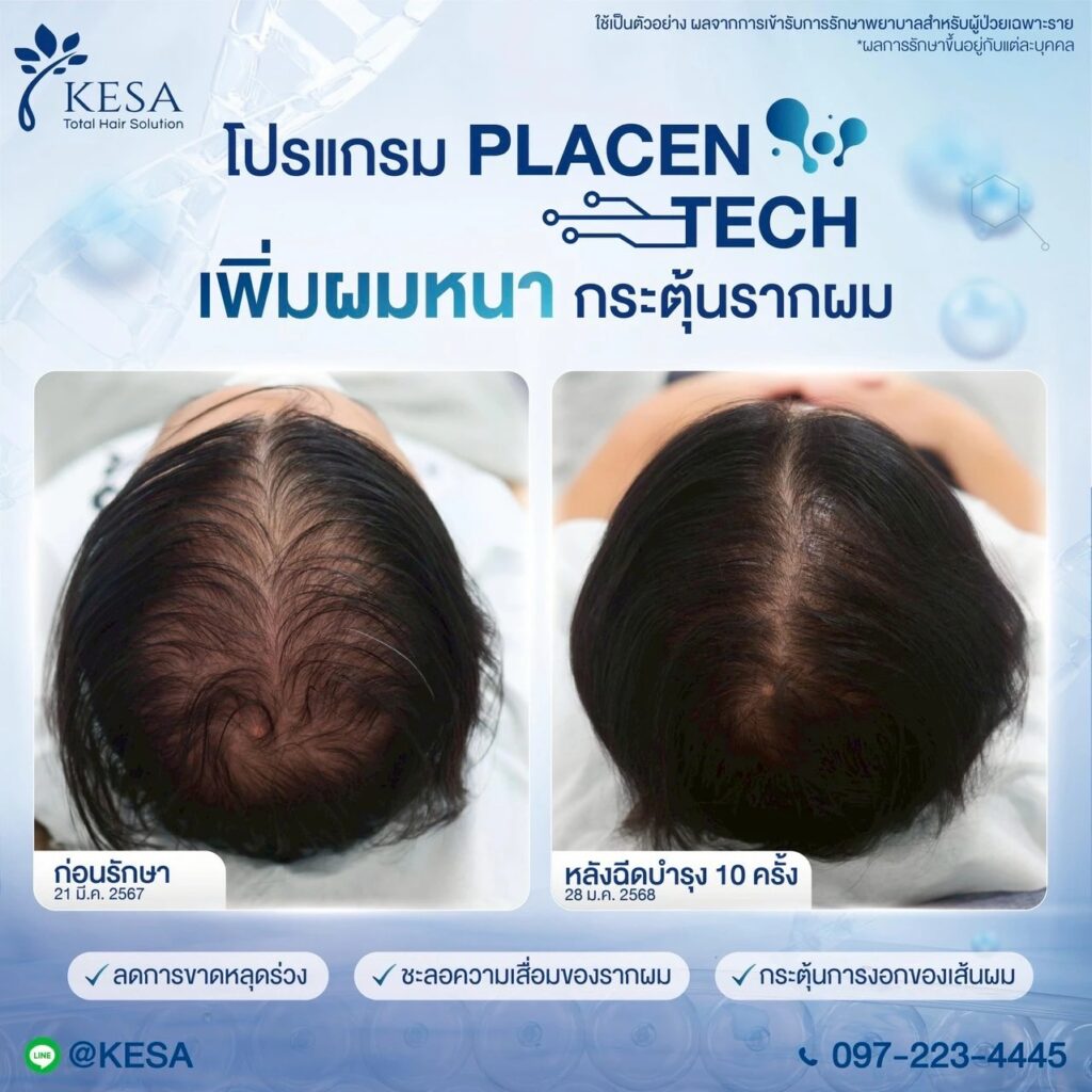 PLACENTECH เกศา คลินิก - kesa hair clinic เกศา คลินิก - kesa hair clinic