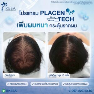 PLACENTECH