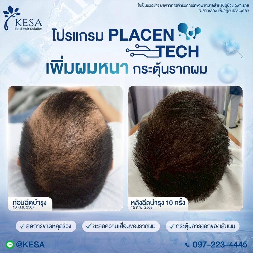 PLACENTECH