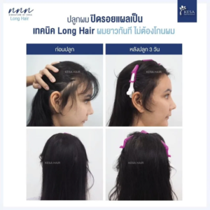 ปลูกผมทับรอยแผลเป็น