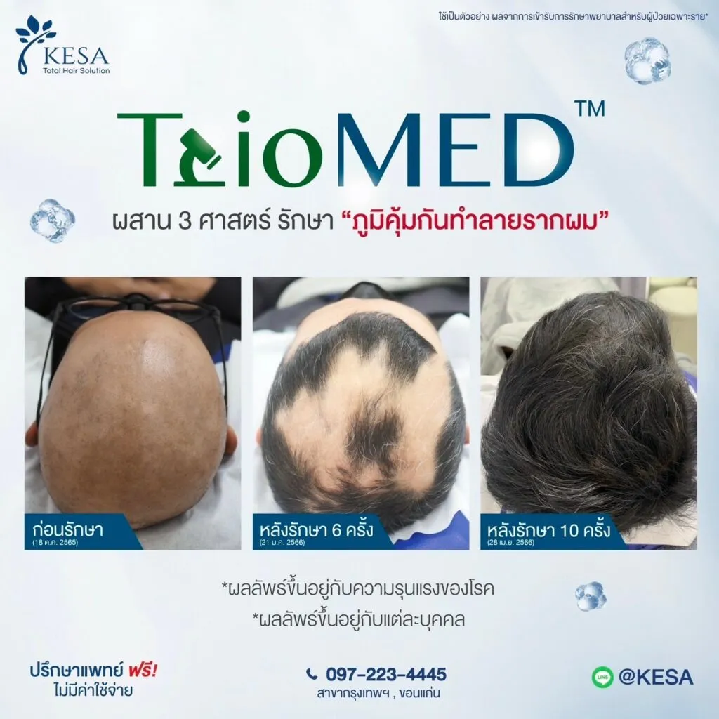 รักษาผมร่วง เกศา คลินิก - kesa hair clinic