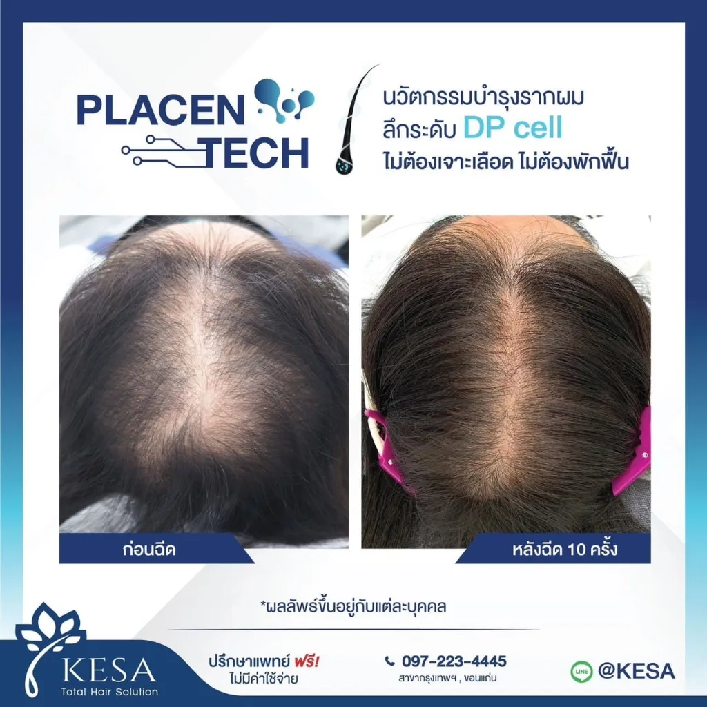 ตรียมผม X PlacenTech เกศา คลินิก - kesa hair clinic