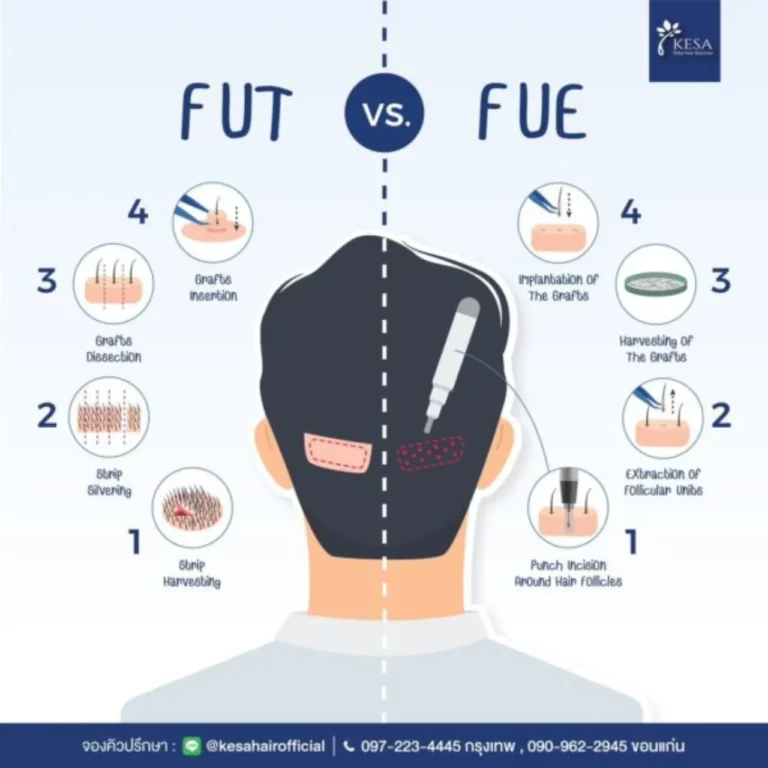 ปลูก ผม FUE คืออะไร เกศา คลินิก - kesa hair clinic