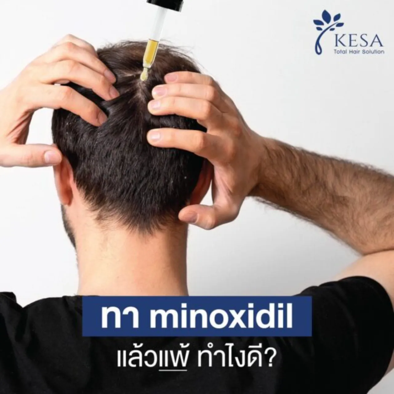 แพ้ Minoxidil แบบทาทำไงดี ?