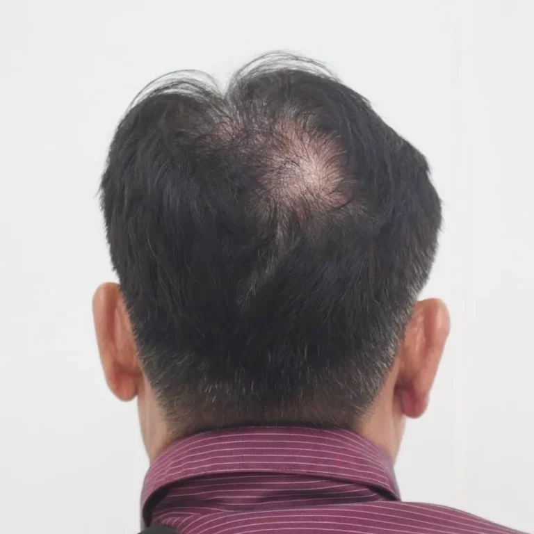 ผมร่วงผมบาง เกศา คลินิก - kesa hair clinic