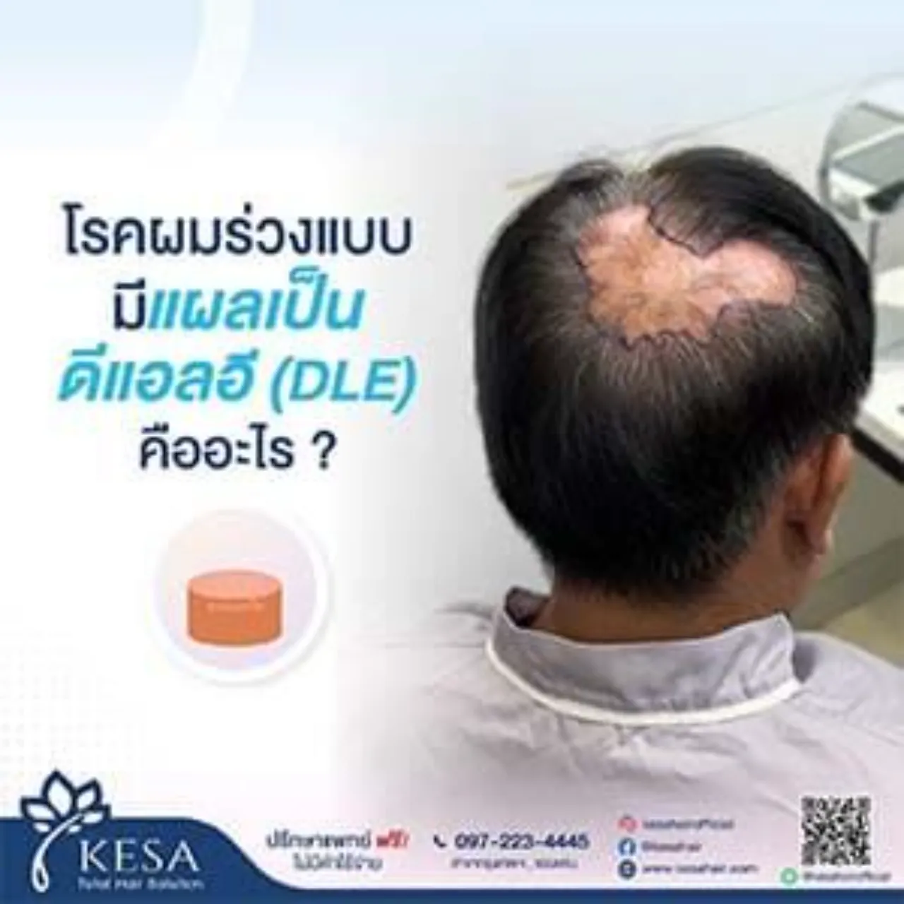 โรคผมร่วงแบบมีแผลเป็นดีแอลอี