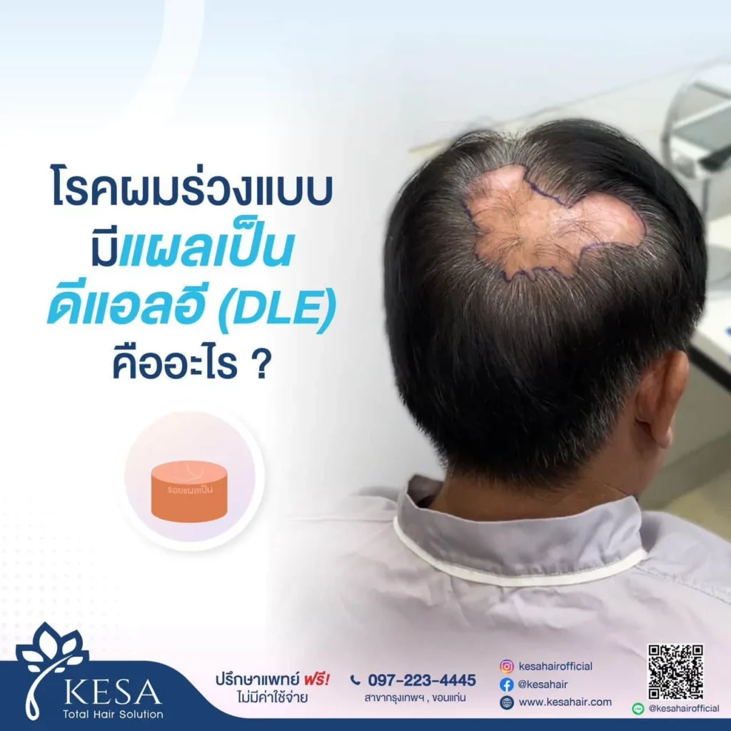 โรคผมร่วงแบบ DLE เกศา คลินิก - kesa hair clinic