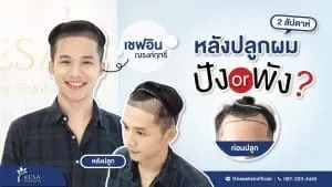 เชฟอิน “กำลังอิน” ผลลัพธ์หลังปลูกผมเทคนิค NNN