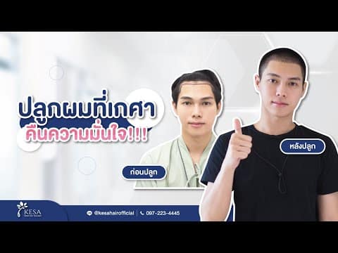 ปลูกผมที่เกศา ความมั่นใจกลับมาอีกครั้ง!!!