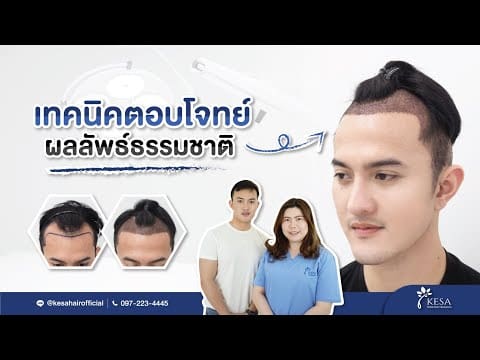 ปลูกผม NNN เทคนิคที่ตอบโจทย์เรื่องผลลัพธ์ธรรมชาติ