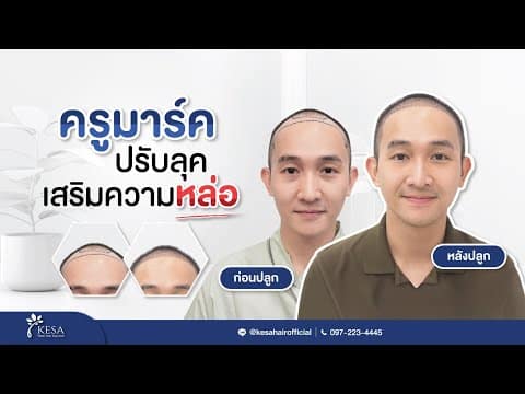 เมื่อครูมาร์คมาปลูกผมเทคนิค NNN