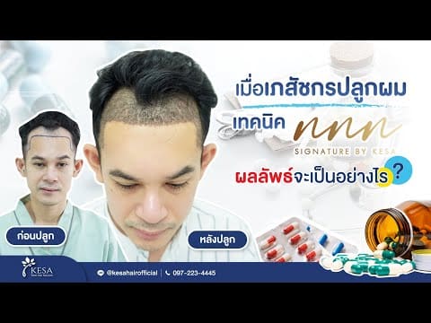 เมื่อเภสัชกรปลูกผมเทคนิค NNN ผลลัพธ์จะเป็นอย่างไร?