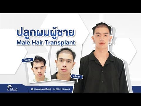 ปลูกผมผู้ชาย Male hair transplant