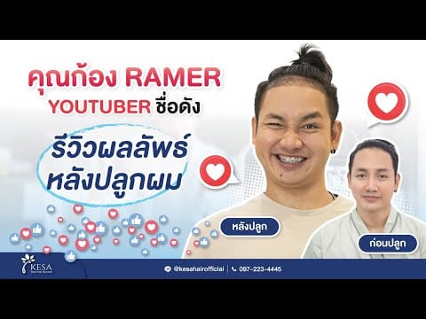 คุณก้อง RAMER รีวิวผลลัพธ์หลังปลูกผมเพียง 2 สัปดาห์ “แนวผมใหม่ กรอบหน้าปังขนาดนี้!!!!”