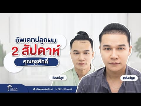 ผลลัพธ์ปลูกผมเทคนิค NNN แก้ปัญหาหน้าผากกว้าง