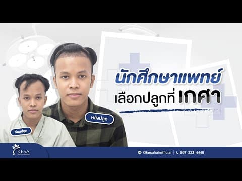 คุณดาว นักศึกษาแพทย์ เดินทางมาปลูกผมเทคนิค NNN ที่เกศาคลินิก ผลลัพธ์จะเป็นอย่างไร?