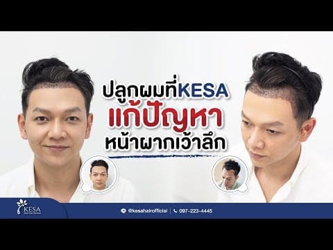 คุณตู่ปลูกผมที่KESA แก้ปัญหาหน้าผากเว้าลึกตัวM