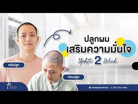 ปลูกผมเทคนิค NNN แก้ปัญหาผมบาง ศีรษะล้าน