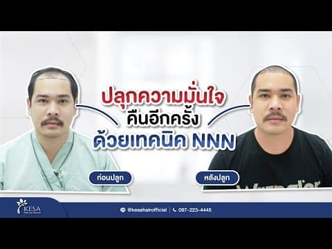 ปลุกความมั่นใจคืนอีกครั้ง ด้วยการปลูกผมเทคนิค NNN