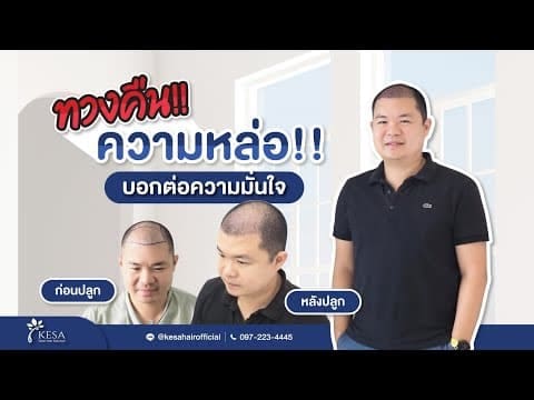 กลับมาทวงความหล่อคืนอีกครั้ง ด้วยเทคนิค NNN