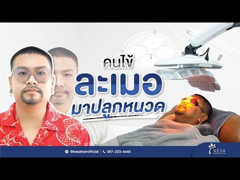 รีวิวผลลัพธ์หลังปลูกหนวด (คุณปั่น RAMER)
