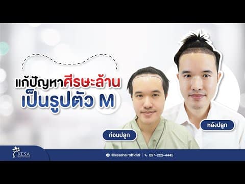 คุณป้องปลูกผมเทคนิค NNN แก้ปัญหาศีรษะล้านเป็นรูปตัว M