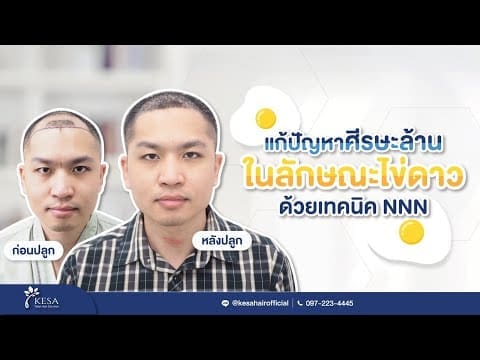 แก้ปัญหาศีรษะล้านในลักษณะไข่ดาวด้วยการปลูกผมเทคนิค NNN ผลลัพธ์จะเป็นอย่างไร?