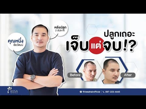 หยุดปัญหาที่ทำให้คุณหมดความมั่นใจ ปลูกผมถาวรด้วยเทคนิค NNN