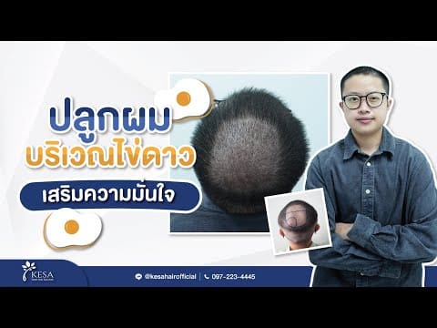 ผลลัพธ์ความประทับใจปลูกผมเทคนิค NNN