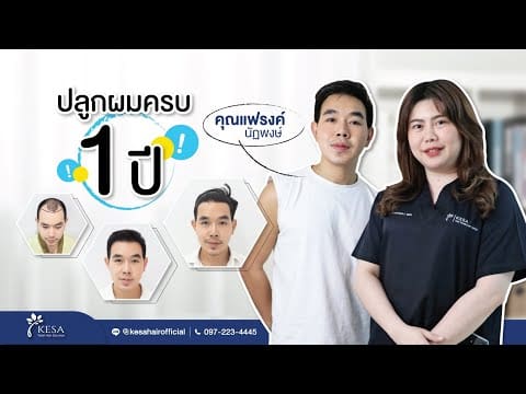 รีวิวผลลัพธ์หลังปลูกผมเทคนิค NNN ครบ 1 ปี ผมขึ้นดกดำเป็นธรรมชาติ