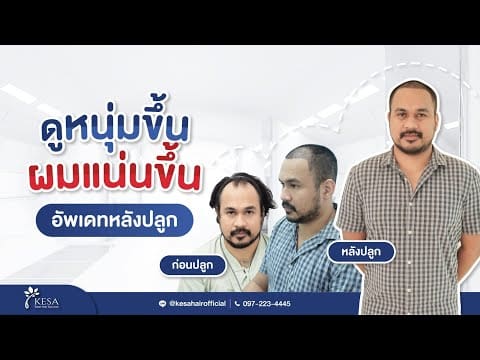 รักษาครั้งเดียวดูหนุ่มไปอีกนาน ด้วยการปลูกผมเทคนิค NNN