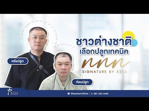 เมื่อเกศาคลินิคปลูกผมเทคนิค NNN ให้ชาวต่างชาติ ผลลัพธ์จะเป็นอย่างไร?