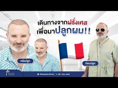 เมื่อบุรุษชาวฝรั่งเศสเดินทางมาประเทศไทย ปลูกผมเทคนิค NNN ผลลัพธ์จะเป็นอย่างไร?