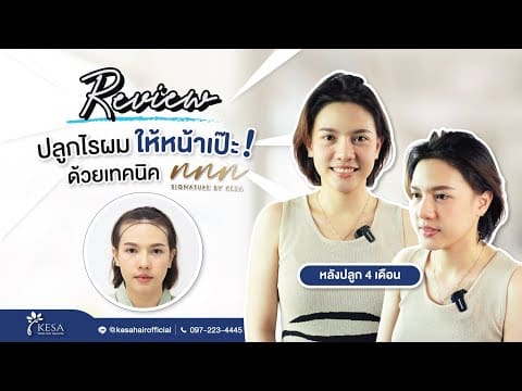 ปลูกผมผู้หญิงเทคนิคNNN