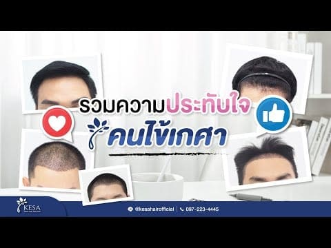 รวมผลลัพธ์ความประทับใจปลูกผมเทคนิค NNN ที่เกศาคลินิก