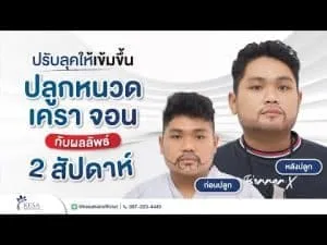 ปลูกหนวด เครา จอน ปรับลุคให้เข้มขึ้น กับ “ผลลัพธ์หลังปลูก 2 สัปดาห์”