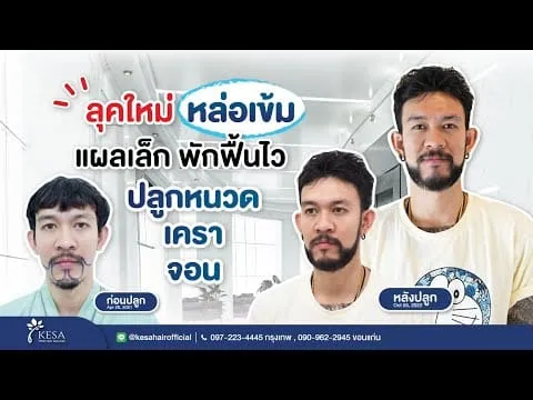 ลุคใหม่ หล่อเข้ม “ปลูกหนวด เครา จอน เทคนิค NNN”