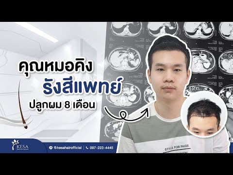 คุณหมอคิง รังสีแพทย์ ปลูกผม 8 เดือน