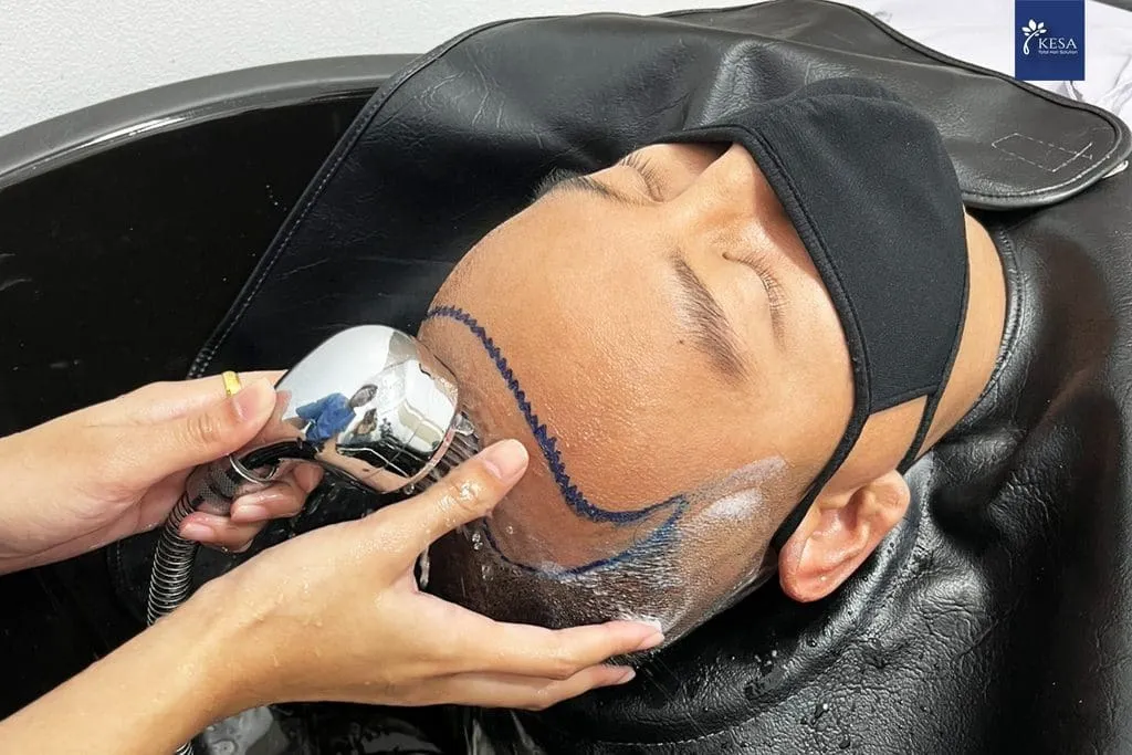 Steps of hair transplantation เกศา คลินิก - kesa hair clinic