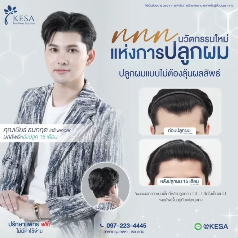 รีวิว ปลูกผม