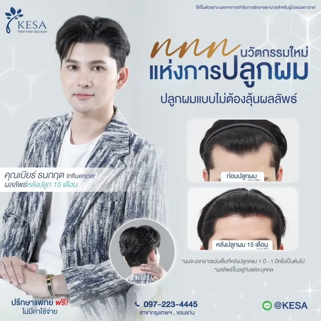 รีวิว ปลูกผม